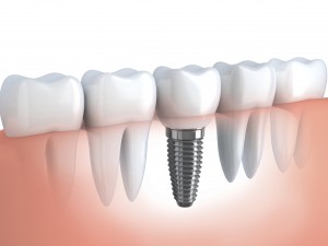 implant dentar suceava