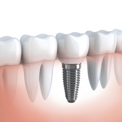 implant dentar suceava